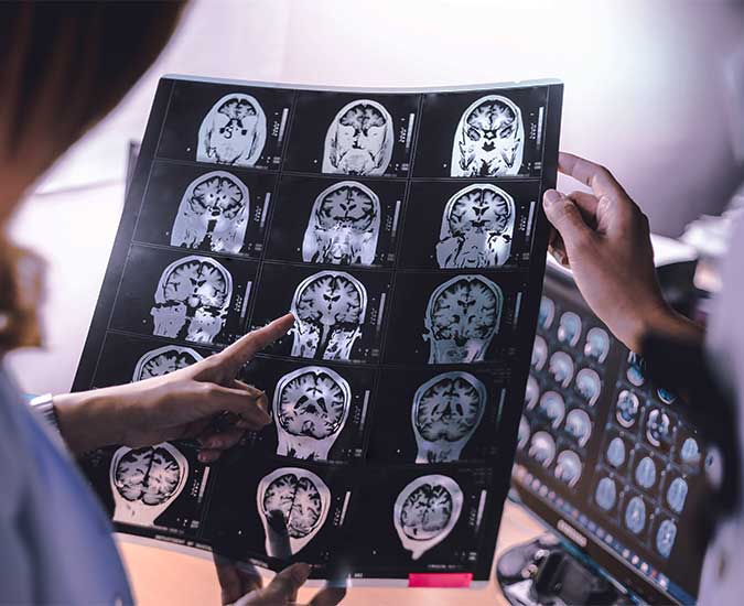 doctors looking at brain scan images to see if a person has signs of dementia